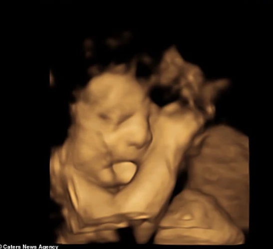A Battle for Survival: Baby Baker Roth's Fight Against a Rare, Life-Threatening Condition 322