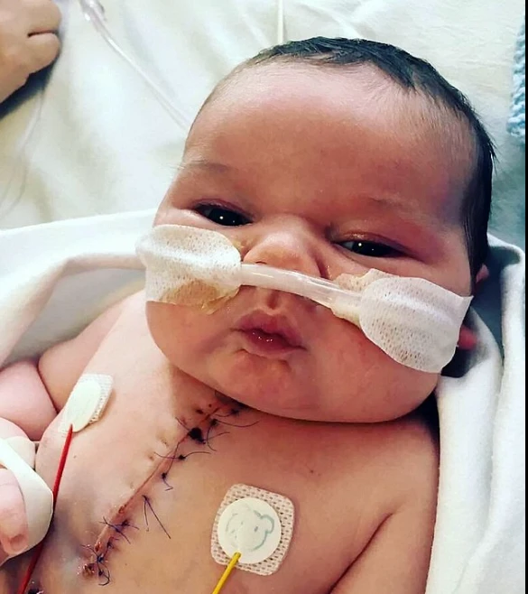 A Miracle of Survival: Reggie's Battle Against Hypoplastic Left Heart Syndrome 352