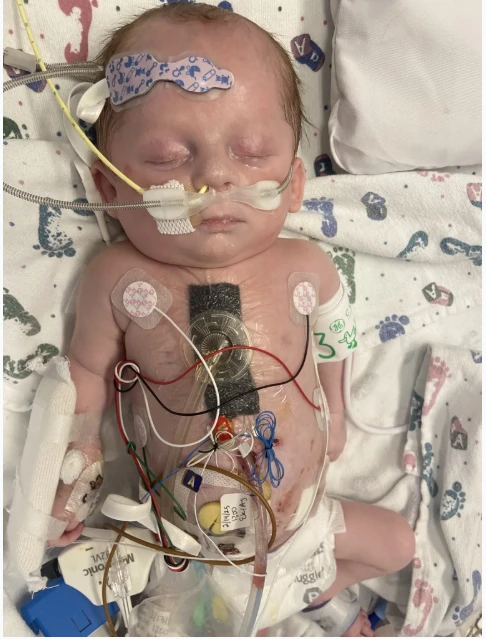 A Fight for Life: Myles' Battle Against Hypoplastic Left Heart Syndrome and Unimaginable Odds 337