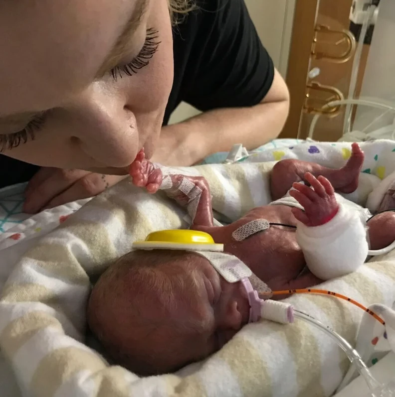 From the Brink of Death to Life: Alex's Miraculous Survival Against Premature Birth 328