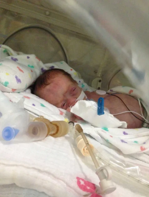 Defying Death: Addie’s Journey Through NEC, Surgery, and the Fight for Survival 346