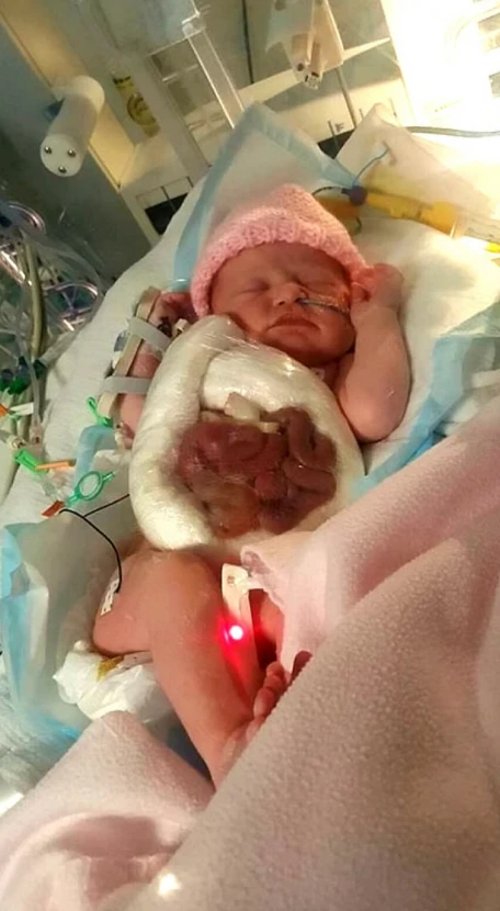 A Mother's Fight for Her Baby: Ava-Rose's Battle Against a Life-Threatening Birth Defect 324