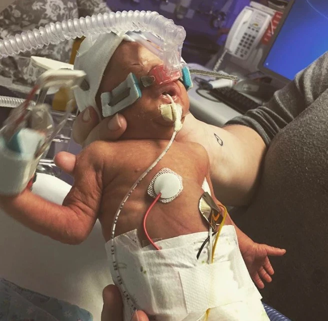 Mylo’s Fight for Life: A Tiny Baby’s Battle Against Severe Heart and Health Conditions 4145