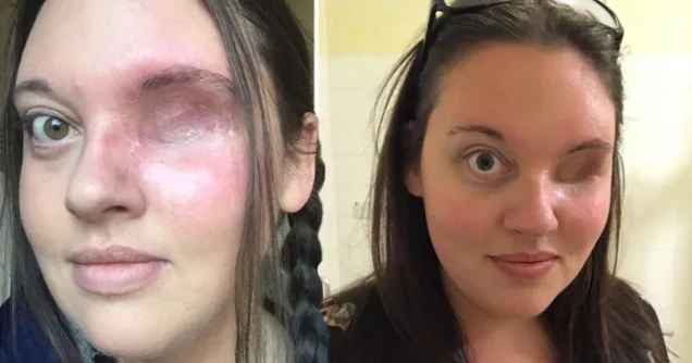 A Fight for Survival: Emma’s Battle with Mesenchymal Chondrosarcoma and the Loss of Her Eye 351