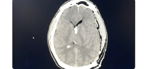 A Sudden Battle for Life: George’s Fight Against a Hidden Brain Malformation 4117