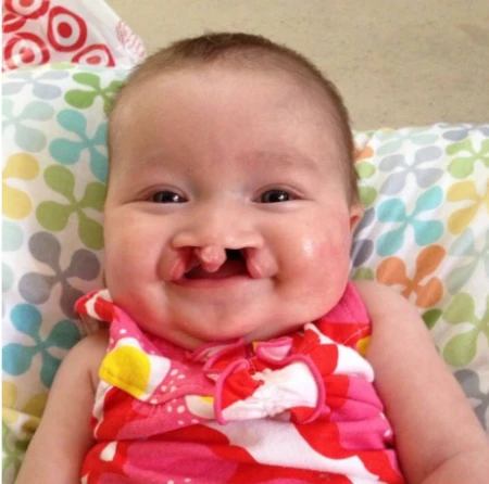 "Kinley's Journey: From Cleft Lip and Palate Surgeries to Thriving Preschooler at Hope and Will's Castle" 6046