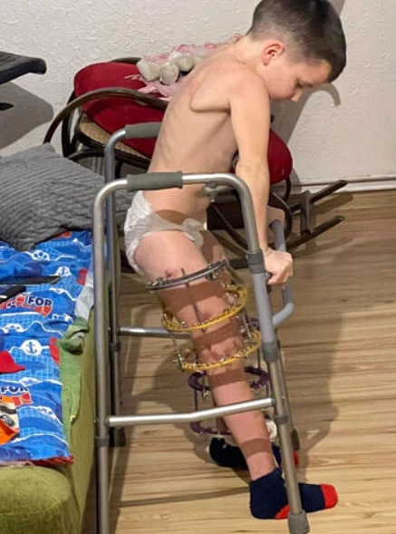 A Journey of Resilience: Kuba’s Fight Against X-linked Hypophosphatemic Rickets 4090