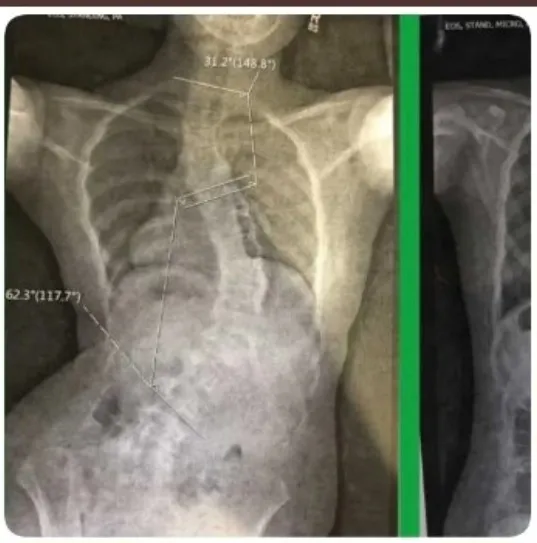 She Just Wanted to Dance—Until a Silent Curve Changed Everything: How Ivey Faced Scoliosis, Pain, and Still Refused to Stop Moving