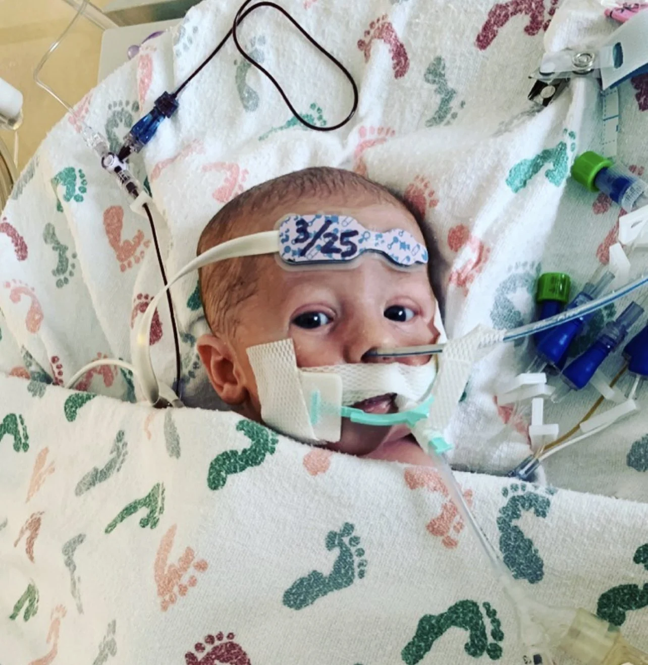 Oliver’s Journey: A Fight for Life Against Congenital Diaphragmatic Hernia 5908