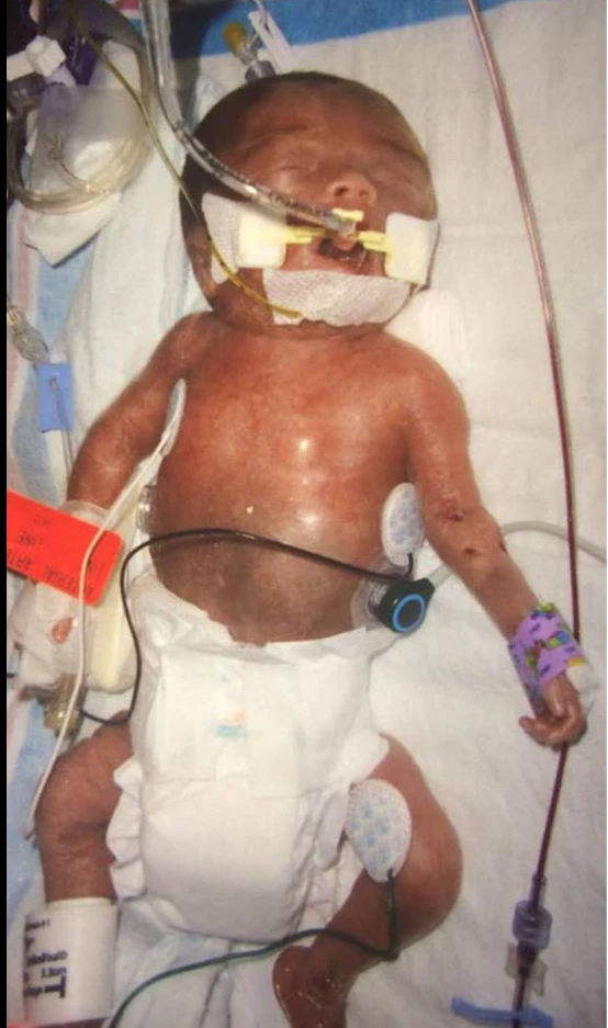 "Aaron’s Journey: From a 1-Pound Micro Preemie to Thriving Little Baseball Player" 6045