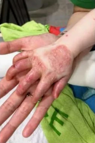 A Fragile Life, A Strong Spirit: Eli's Journey with Epidermolysis Bullosa 4150