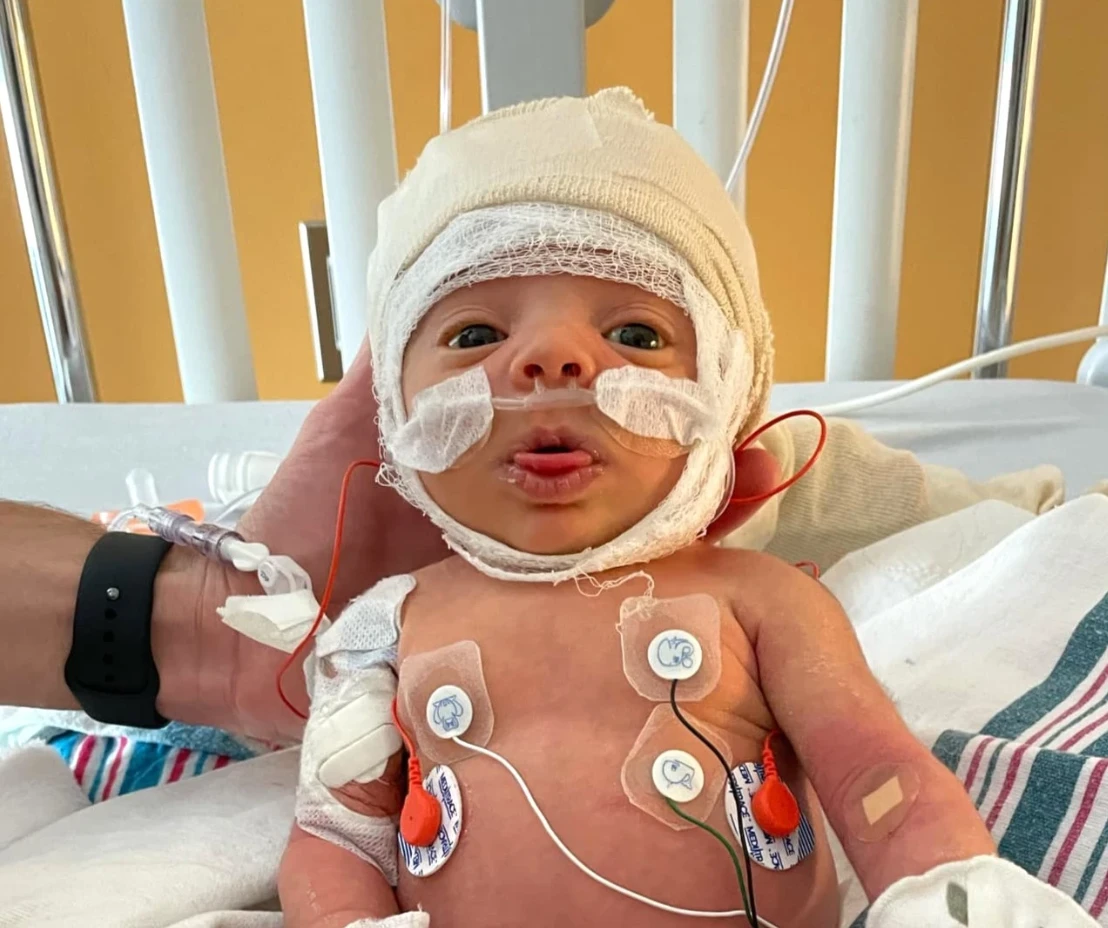 A Fight for Survival: Romy’s Battle with Beckwith-Wiedemann Syndrome 4078