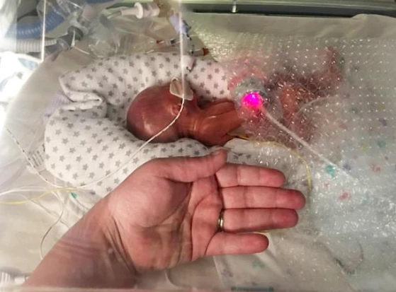 A Miracle of Survival: Austin's Battle Against a Rare Heart Defect 326