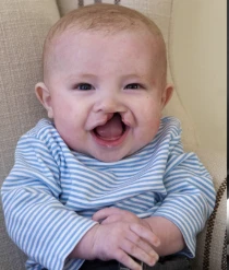 From Before Birth to Big Smiles: How Connor Overcame a Complex Cleft Lip and Palate with Expert Care and Unwavering Support 5858