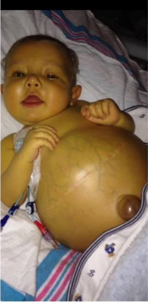 "Jackson’s Journey: From Biliary Atresia to a New Beginning with a Liver Transplant" 6048