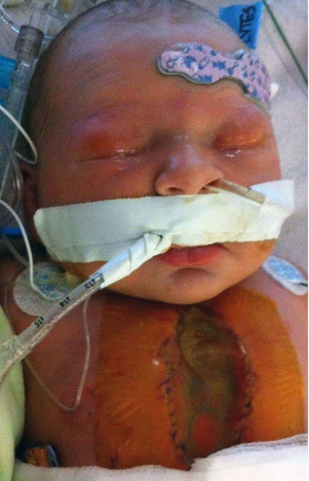 "Annie’s Heart Journey: From Open Heart Surgery at Birth to a Thriving 3-Year-Old" 6042
