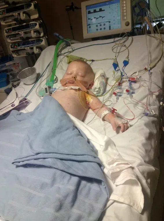From Chickenpox to Crisis: A Baby’s Battle with Flesh-Eating Bacteria 4083